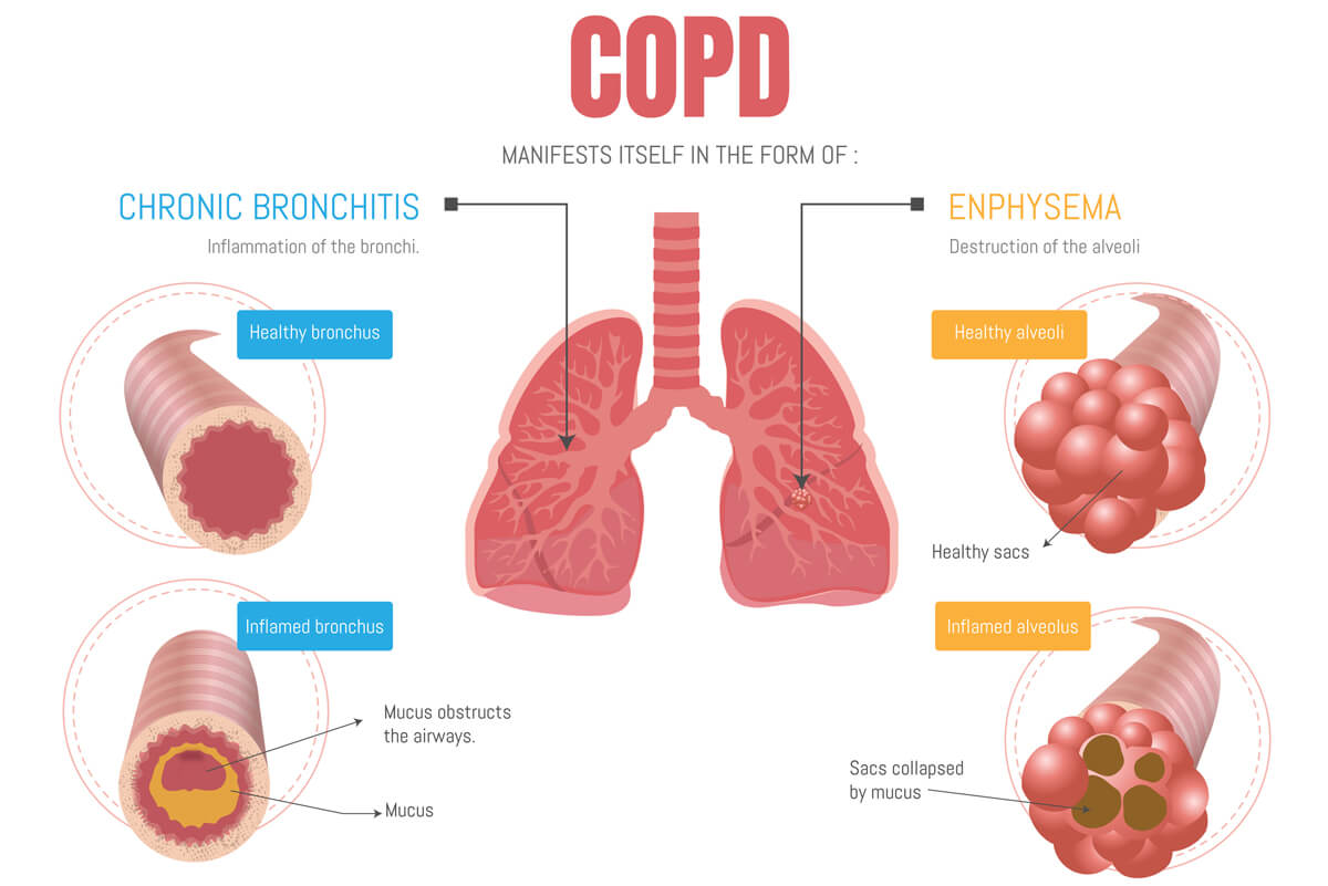 COPD