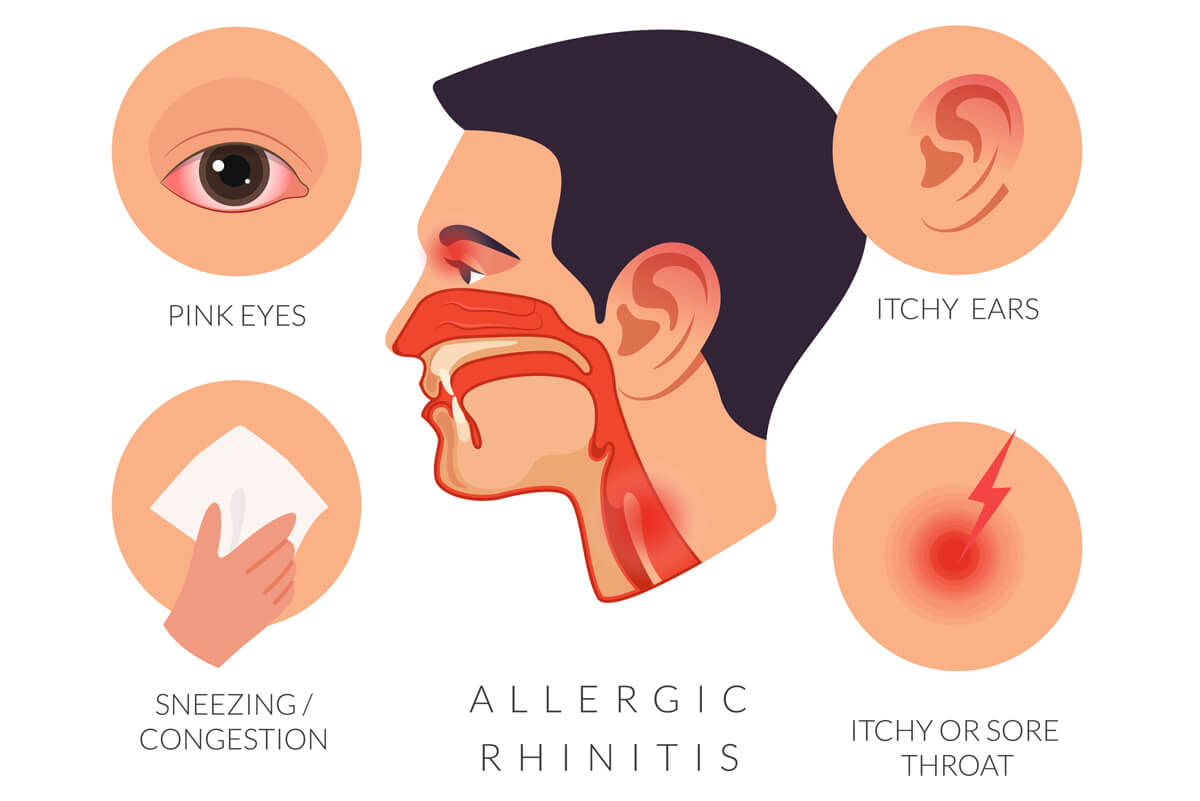 Allergic Rhinitis