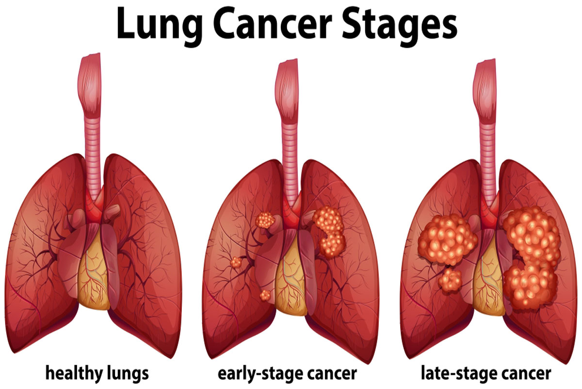Lung Cancer