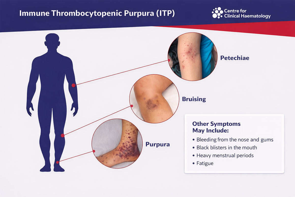 Immune Thrombocytopenia
